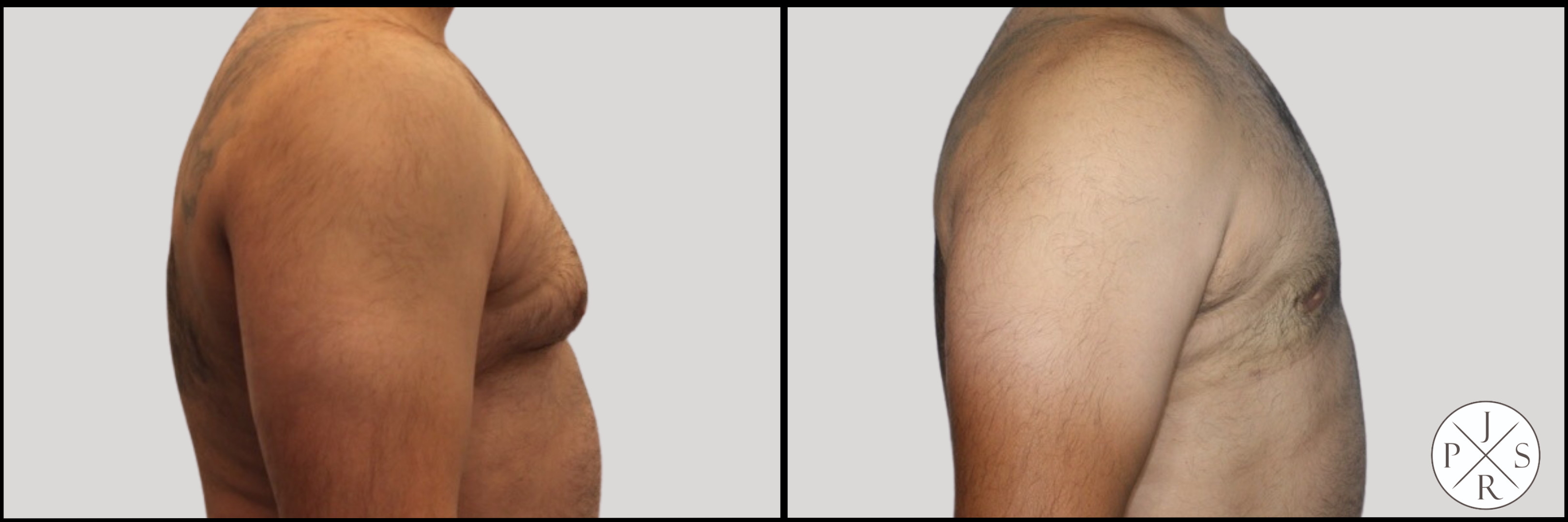 Gynecomastia Before & After Image